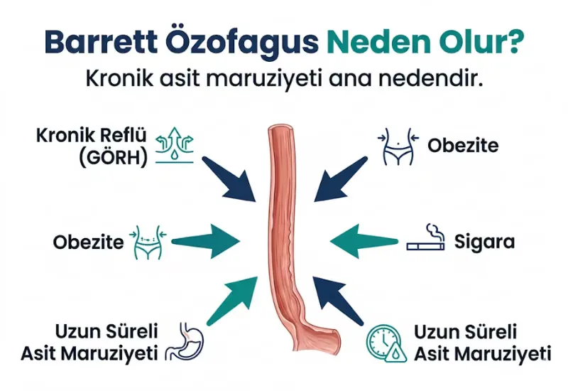 Barrett özofagus belirtileri reflü yanma yutma güçlüğü