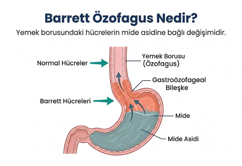 Barrett özofagus nedir belirtileri tedavisi kapsamlı rehber infografik