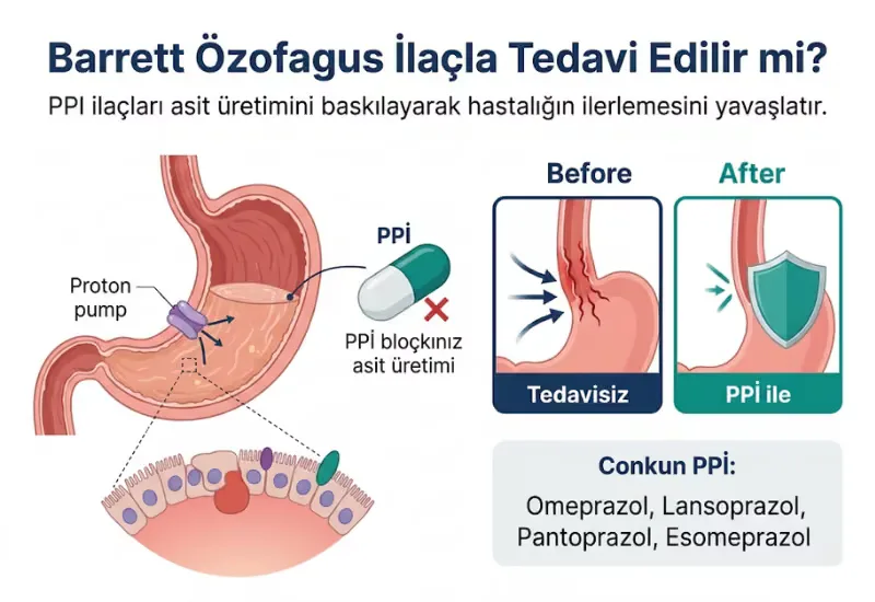 Barrett özofagus ilaç tedavisi PPI H2 bloker antasit