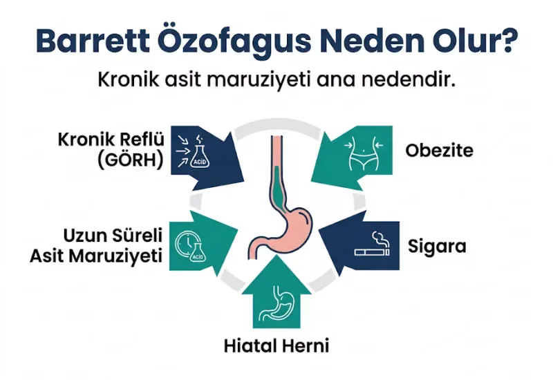 Barrett özofagus nedenleri reflü obezite sigara