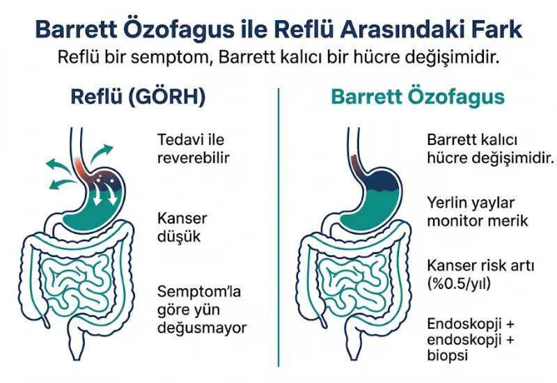 Barrett özofagus reflü farkı karşılaştırma tablosu