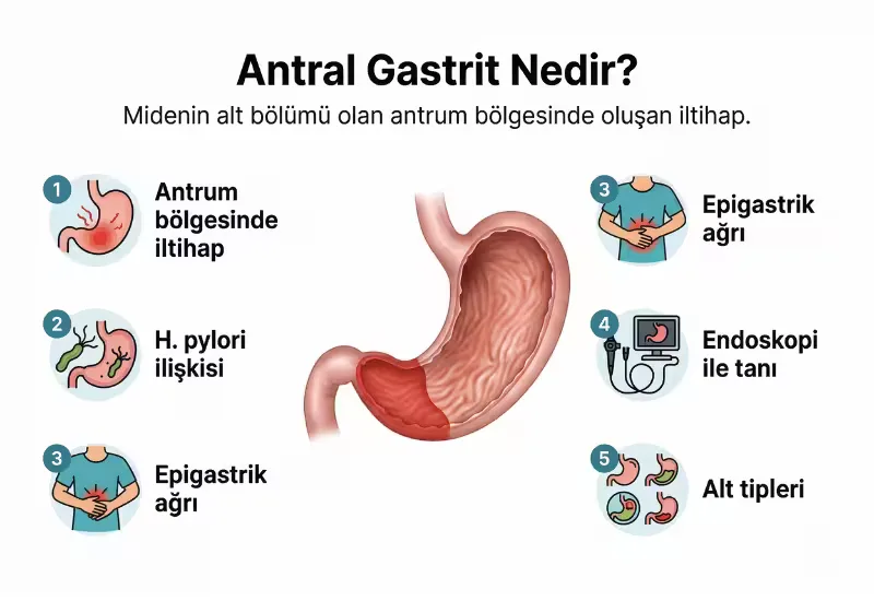 Antral gastrit nedir infografiği