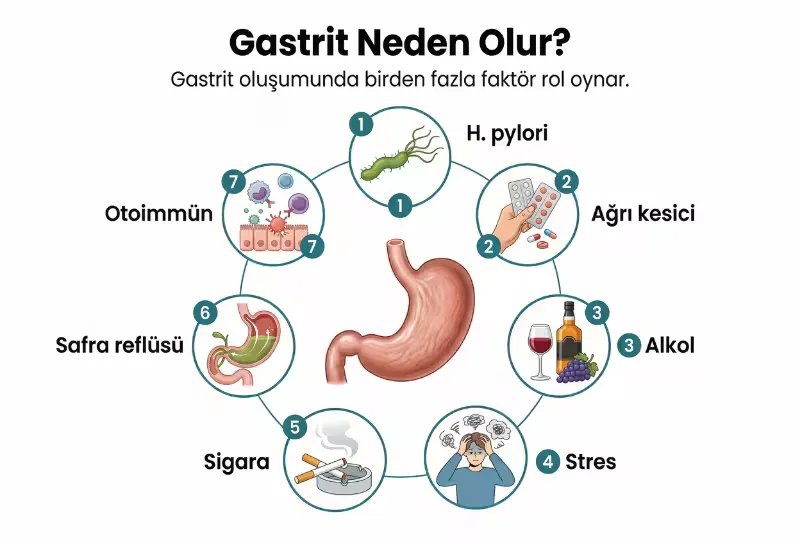 Gastrit nedenlerini anlatan infografik