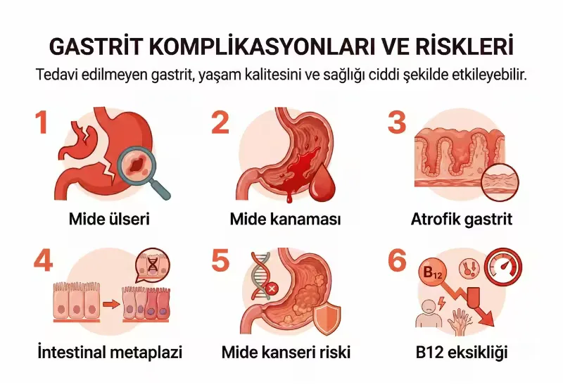 Gastrit tedavi edilmezse komplikasyonları anlatan infografik