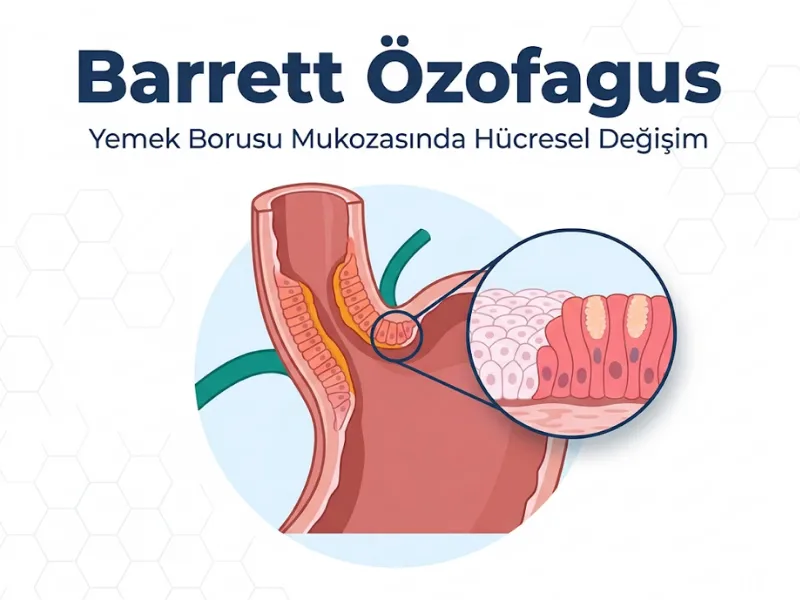 Barrett Özofagus