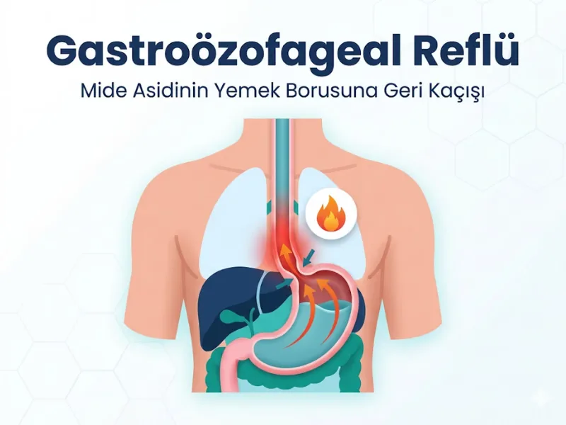 Gastroözofageal Reflü