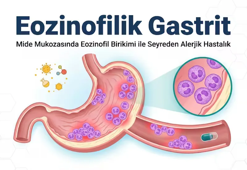 Eozinofilik gastrit nedir mide mukozasında eozinofil birikimi