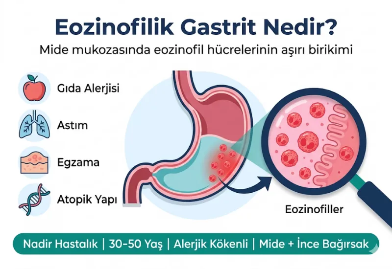 Eozinofilik gastrit nedir mide mukozas\u0131nda eozinofil birikimi