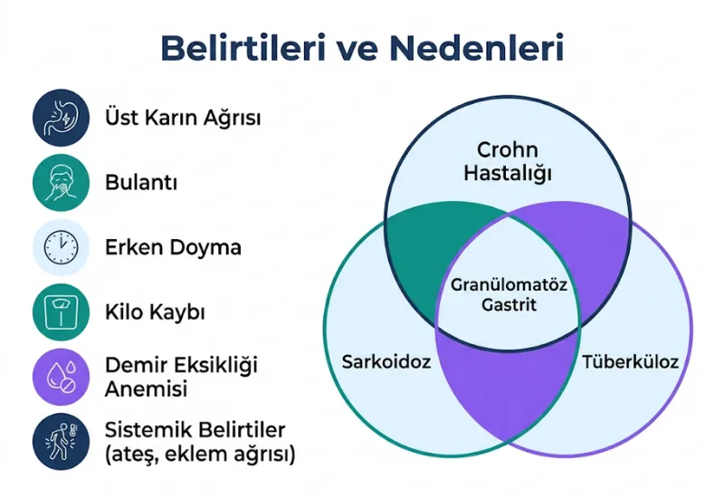 Granülomatöz gastrit belirtileri nedenleri crohn sarkoidoz tüberküloz