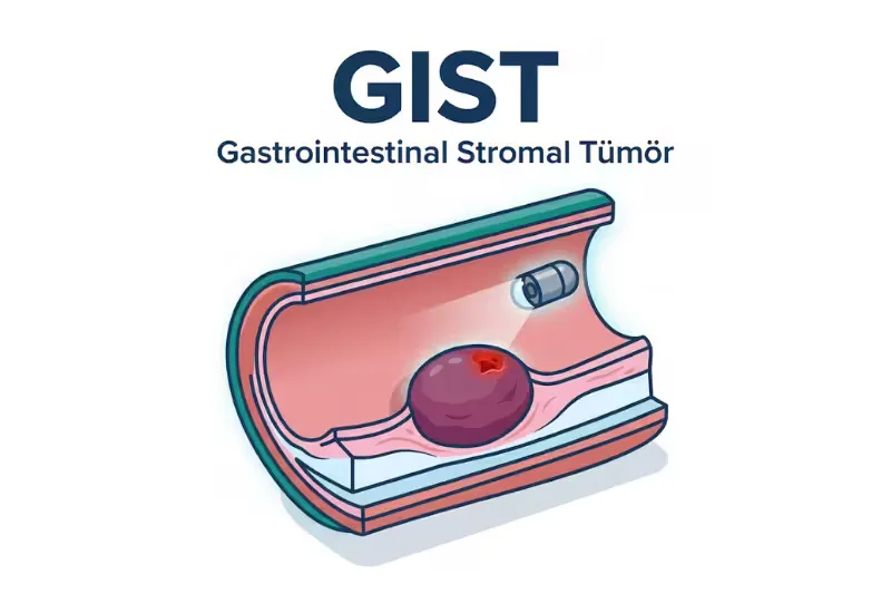 GIST gastrointestinal stromal tümör nedir